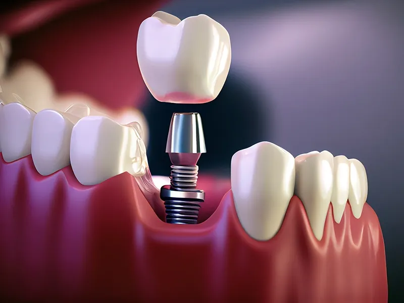 دندانپزشکی ایمپلنت چیست؟